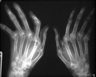 end angulation except) 4th finger 1. Hand deformity 2.