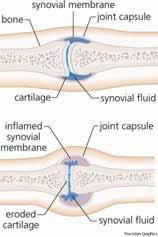 Ulnar deviation MCP Jt capsule & collateral ligament laxity Problem in cosmetic area,