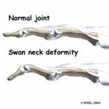 Physical Therapy and Rehabilitation: PT 12 Volar movement of lateral band Shortening of oblique retinacular ligament