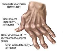 Swan-neck deformity Flexor tenosynovitis with laxity of PIP Jt capsule & accessory collateral ligament Dorsal