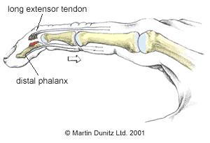 Swan-neck deformity 3. RA deformity of Finger d.