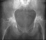 Symptoms of RA hip :arthritis pain & loss of motion 2.