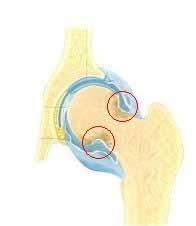 Rheumatoid knee 1) Phase I a. Soft tissue involvement b.