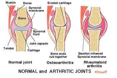 Capsular Swollen & Stret surrounding ligament e.