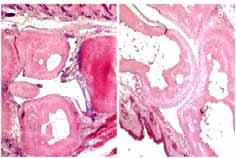 Synovial stage b. Pannus formation c.