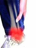 Physical Therapy and Rehabilitation: PT 14 a. Cartilage destruction b.