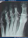 Periarticular swelling d/t induration 4) Phase IV a. Cartilage destruction b.