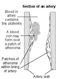 humoral factors 2) Inhibition recruitment of neutrophils & monocyte in inflamed site 3) Modify increased capillary