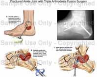 State IV Jt destruction B. [Arthrodesis] : rare. 1. Synovectomy 2.