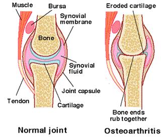 How weakened ligament lead to OA C.