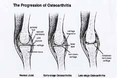 The joint most often affected by OA 5.