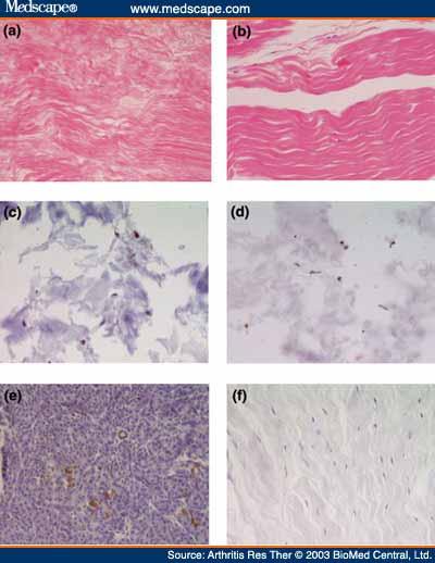 Physical Therapy and Rehabilitation: PT 24 1) Phase I [collagen bond]. (MMPs). (MMPs) (TIMP 1,2). 2) Phase II (fibrillation) (erosion) PG. 3) Phase III. -1(IL-1), (TNF-a) (MMPs).