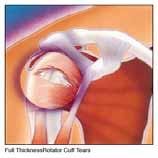 Shoulder girdle pain & referral pain b.