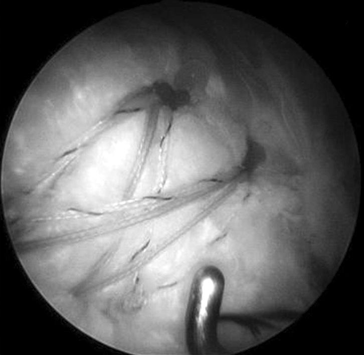 (B) Lateral migration of two pairs of suture fibers.