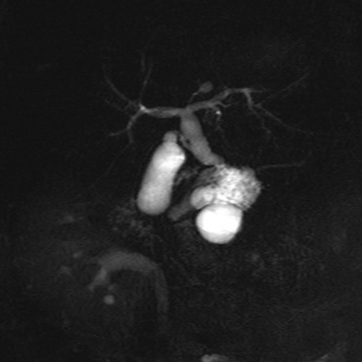 MRP () and T1-weighted enhancing axial MR image () show that this mass has many internal lobules and subtle
