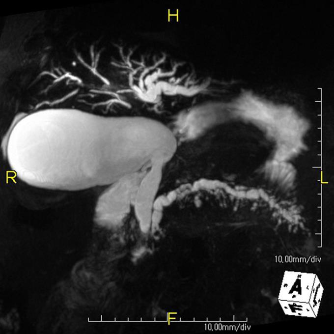 T2-weighted axial MR image () shows diffuse main pancreatic duct dilatation and multiple branch duct dilations.