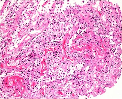 The ampulla of Vater tumor shows clear to eosinophilic ovoid cells with marked degenerative changes and an abundant vascular network (, hematoxylin and eosin stain, 200).