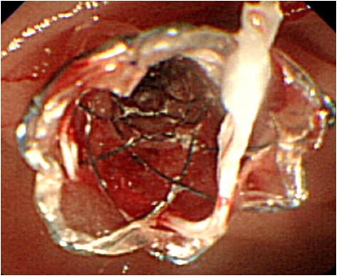 강종식 외 6인. 신세포암의 바터 팽대부 전이 Figure 5. Duodenoscopic and endoscopic retrograde pancreatographic findings.
