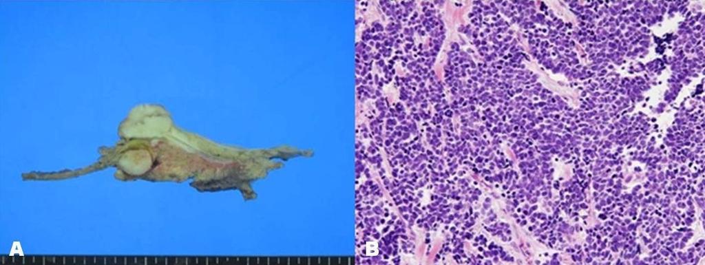 바터팽대부소세포암의조영증강초음파증례 25 Fig. 3 A. Gross examination revealed a well demarcated exophytic polypoid mass, measuring 2.9x 2.3cm, in ampulla of Vater. The tumor directly invaded pancreatic parenchyme.