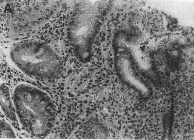pylori 의 검출의빈도는 람에게서는질병이발생하지않으나일부에서 불완전장형화생이 16% (9/56) 이었고 (Fig. 1. 는십이지장궤양, 위궤양또는위암에 이완되 A) 완전장형화생에서는 H. pylori를검출할수 는현상을설명하기위하여 H. pylori의 병독성 가없었다 (Fig. 1. B). 에 의한차이일것이라는의견도제시되고있 N.