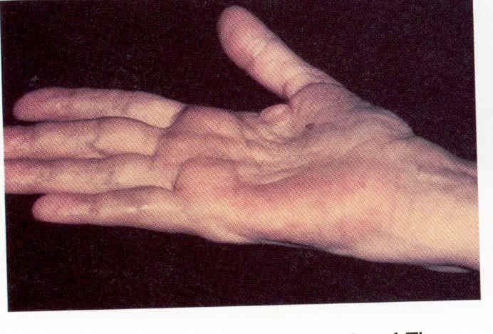 근골격계 : 특수검사 Phalen s test( 팔렌검사 ) 손에통증과 numbness