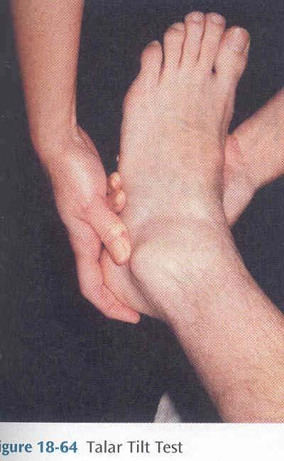 근골격계 : advanced technique Talar tilt test 발목 sprain 사정 환자는발을아래로하고앉게한다 환측발목을감싸쥐고엄지를복숭아뼈아래에둔다 수동적으로발목 invert/evert를시켜본다