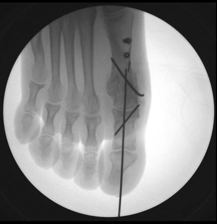 dditional proximal metatarsal and kin osteotomies and combined lesser toe correction procedures were performed () to correct recurred hallux valgus (). 4. 무지내반변형무지내반변형은무지외반의수술적치료후그리드물지않은합병증중하나다.