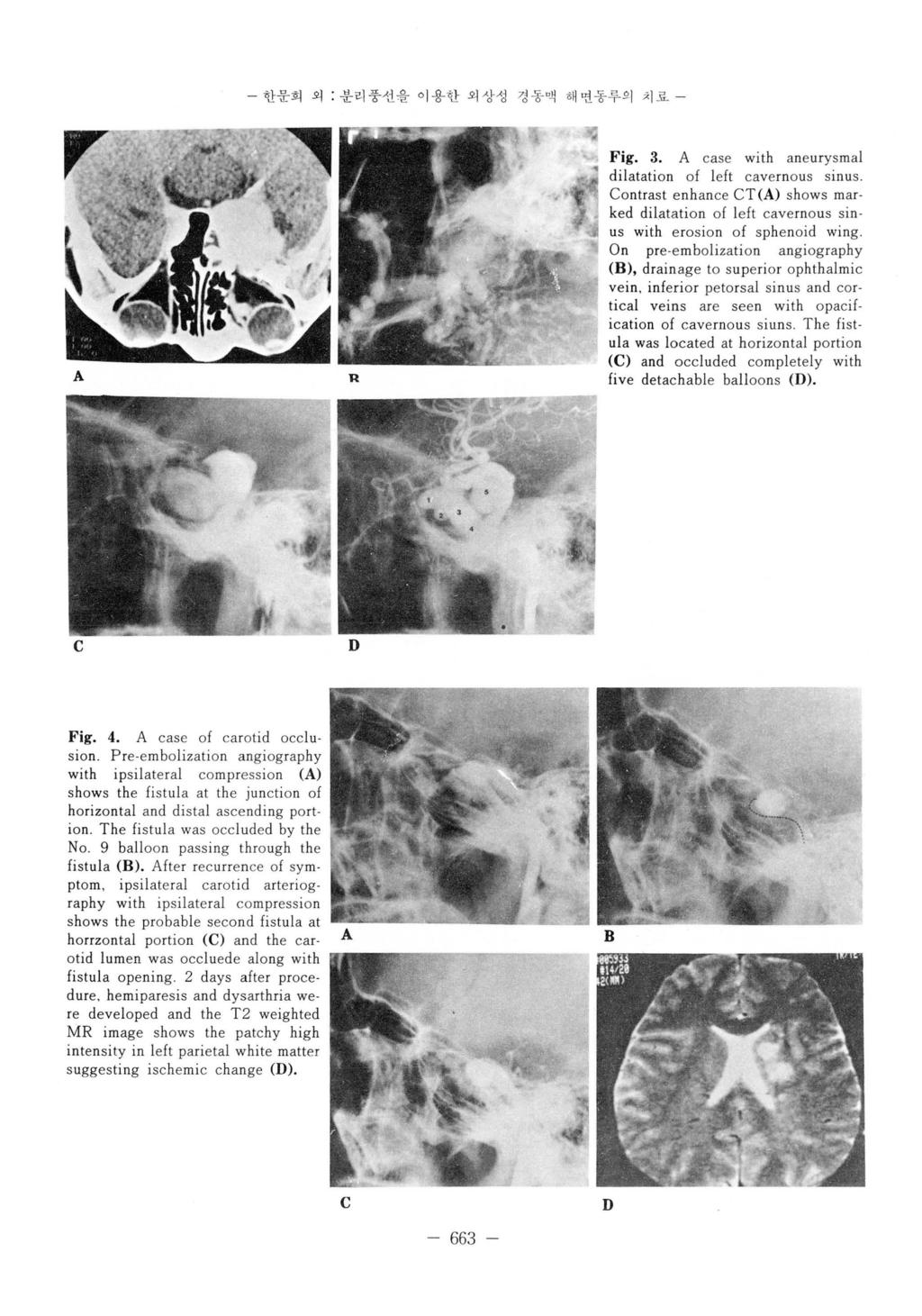 한운희외 : 분리풍선을이용한외상성경꽁액해연동루의치료 - A R Fig. 3. A case with aneurysmal dilatation of left cavernous sinus Contrast e nhance CT (A) shows mar.