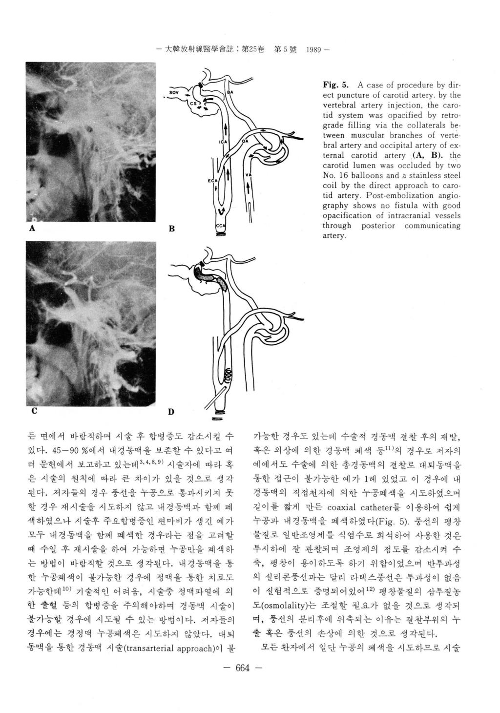 - 大韓放射線훨웰會픔 第 25 환第 5 號 1989 A B Fig, 5, A case of procedure by direct puncture of carotid artery.