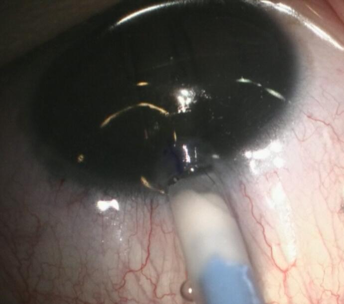 8 mm blade. (D) Implantable collamer lens implantation through the incision.