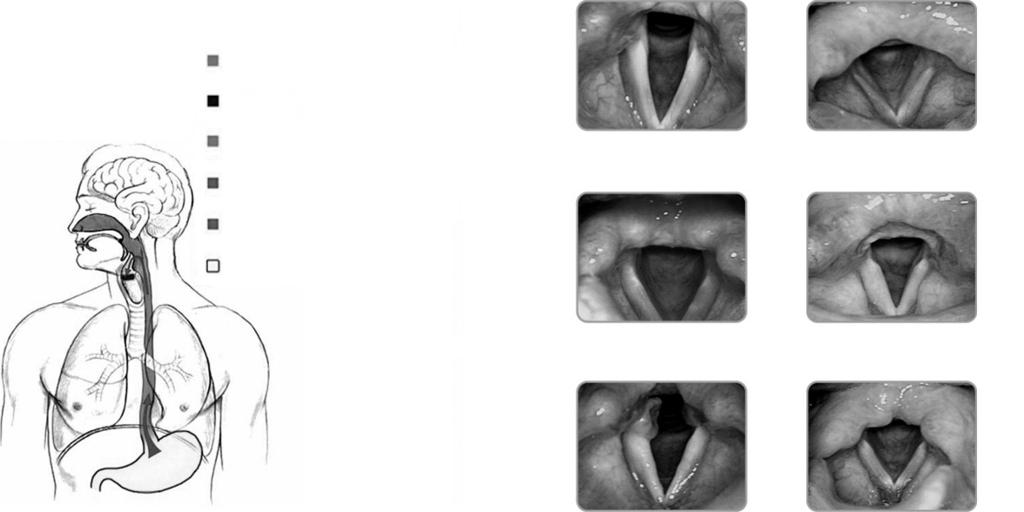 (Upper esophageal sphincter relaxtion) 4) 식도기 (Esophageal stage) 위식도내시경시접하게되는구강및인후두의소견 1. 구강및구인두 1) Mallampati classification 2.