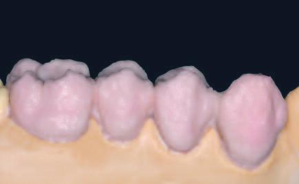 1 차 dentin 과 Incisal 소성 Dentin과 Incisal 재료를축성하기전모델을격리하십시오. 이러한방법으로, 도재가건조되거나모델에달라붙는것을방지할수있습니다.