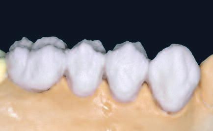 Dentin 과 Incisal 재료를사용한수복물의보충 교합면의최종디자인 2 차 dentin 과 Incisal 소성을위한소성변수 T B S t / H V 1 V 2