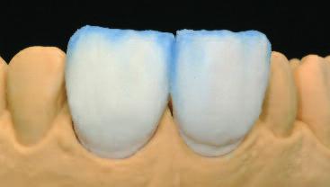 IPS InLine Veneer Incisal 소성 그후,