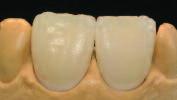 Incisal 소성을위한소성변수 T B S t / H V 1 V 2 930/1706