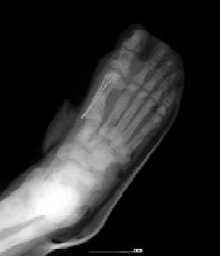 (B) In lateral radiograph, bone within a bone in distal tibia and calcaneus is manifested. Fig.
