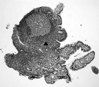 (B) Photomicrograph showing benign reactive lymphoid follicle with an active germinal center (arrowhead; H&E, 100). 가족성선종성용종증 6명의환자에서는모두대장전체에걸쳐목이없고바닥이넓은용종이관찰되었다.