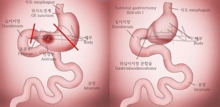 근위부위아전절제술 Radical Subtotal Gastrectomy 4. 병합절제 5.