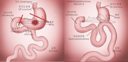 Gastrectomy 위전절제술 Total Gastrectomy
