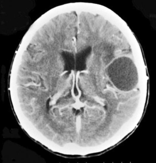 Intra abdominal fluid collection with irregular peritoneal line was noted. Figure 4.