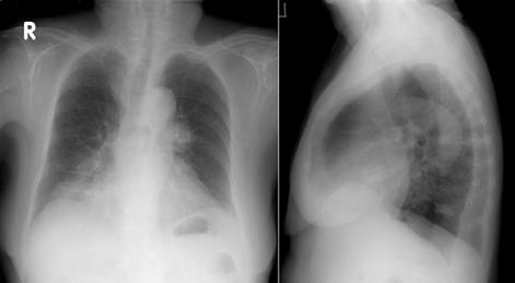 - 시계동외 5 인 : 유전자형검사를통해진단된자궁경부암의기관지내전이 1 예 - Figure 1. Chest P () and lateral view () show diffuse increased densities in both lower lung zones. 2예가보고되었을뿐이다 8).
