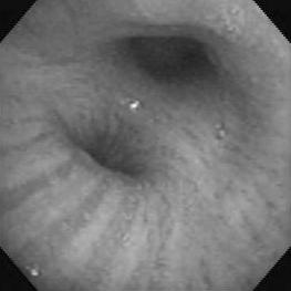 () ronchoscopy shows irregular mucosal nodularity at the orifice of the right middle lobe and a blunted spur between the