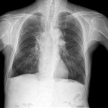 한결과에서반응율이 1주에는차이가없었으나 1개월에는광역동치료군이 Nd-YAG 군보다나은결과를보였다 ( 유럽 61%; 36%, 미국 42%; 19%). 조직검사를통한완전관해를확인하였을때역시광역동치료군이 Nd-YAG 군보다나은결과를보였다 ( 유럽 12%; 3%, 미국 6%; 5%) 15.