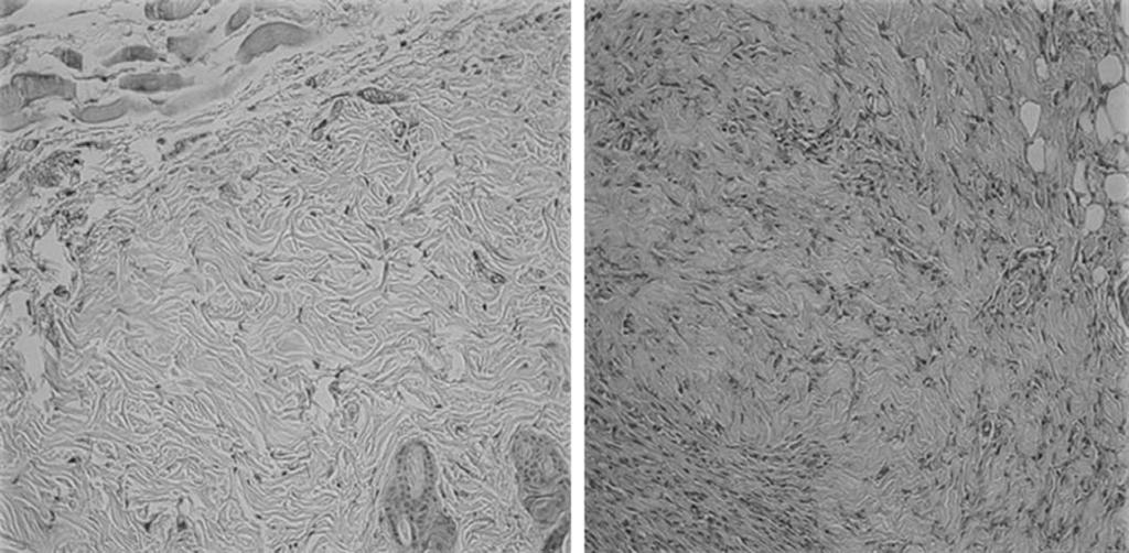 The expression of VEGF in Suture+PDRN group was significantly increased compared to the Suture group (p<0.05). 봉합술과같이적용하였을경우창상의초기치료증진과조직학적치료에도움이될수있다. 참고문헌 *: p<0.05 01.