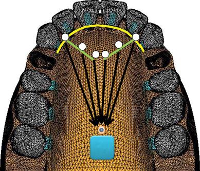 slope; c, continuous arch with lever arms and miniscrew in the midpalatal suture area; d, segmented arch with lever arms and miniscrew in