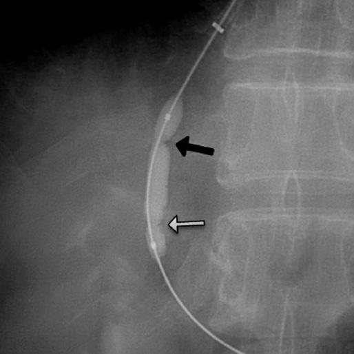 The waists in the balloon indicate the location of the hepatic vein (solid arrow) and the portal vein (empty arrow), while the tract is located between the two. C.