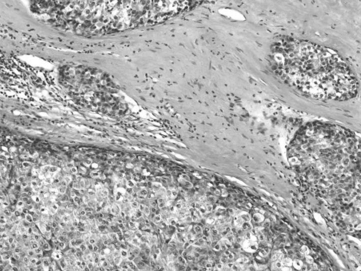 CombinedHepatocelular-Cholangiocarcinoma 에있는종양세포는간세포와담관세포의중간형을보이는경우가있다. 면역조직화학염색을하면이부위에있는중간형의종양세포는혼합표현형 (mixedphenotypes) 을보인다. 1 5.2.