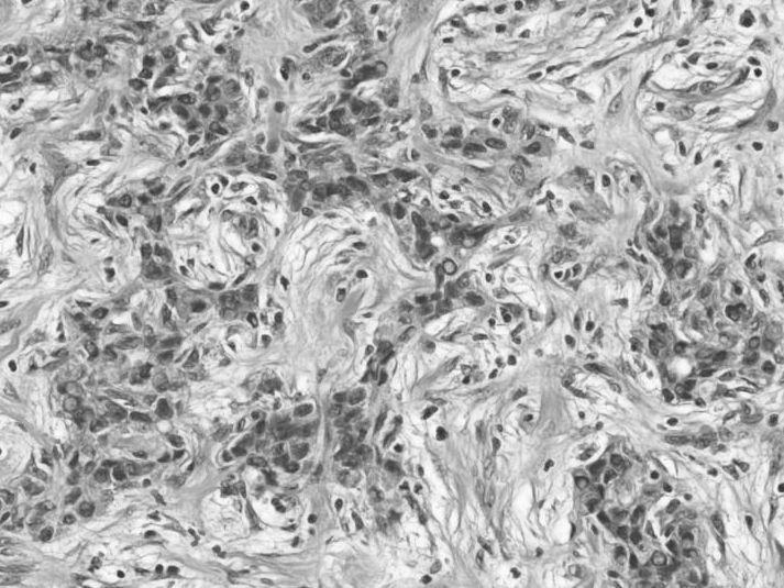 종양세포는섬유기질에세관 (tubular), 코드모양 (cord-like), 사슴뿔모양 (antler-like) 의배열이특징이다. 종양세포는헤링관혹은담세관을닮았다 (Fig.7). 점액분비는없다. 면역조직화학염색에서종양세포는간줄기세포표지자인 cytokeratin19,kit,cd 56,EpCAM 등에양성이다. 종양세포의비정형은약하고점액은분비되지않는다.