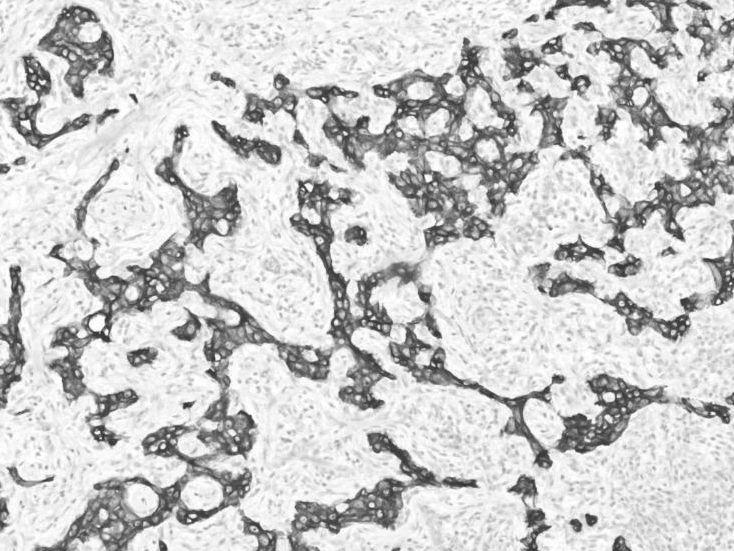 CombinedHepatocelular-Cholangiocarcinoma 수있다. 2 넷째, 간세포암종이거짓샘을형성할수있어복합간세포 -담관암종으로오인해서는안된다. 이경우거짓샘은간세포를닮은종양세포로이루어져있고담즙을분비하는점이담관암종과의감별점이다.