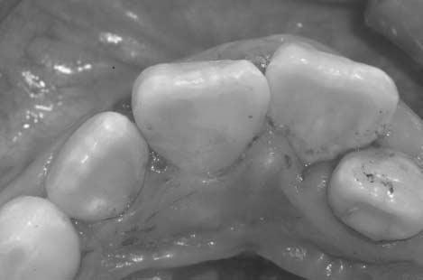 Partial pulpotomy The crown-fractured tooth is